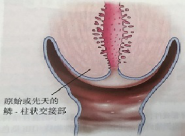 宮頸癌篩查沒那么簡單，這些技巧助你提高取樣質量
